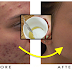 Ways To Lighten Scar On Your Face Due To Pimples!