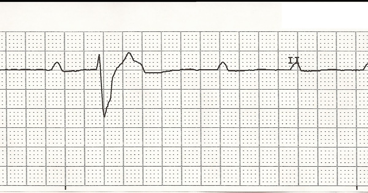 EKG Rhythm Strips 35