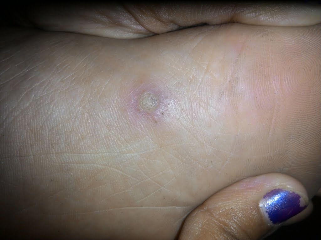 An infected corn on foot cured by homeopathy Homoeoscan Homoeopathy