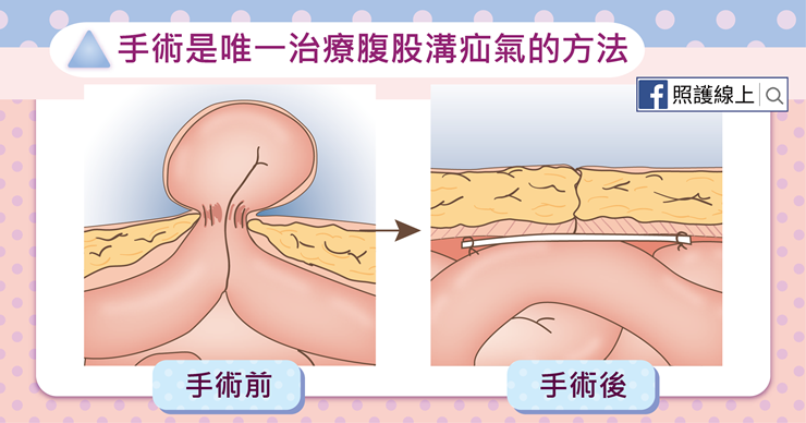 用手術治療腹股溝疝氣-照護線上