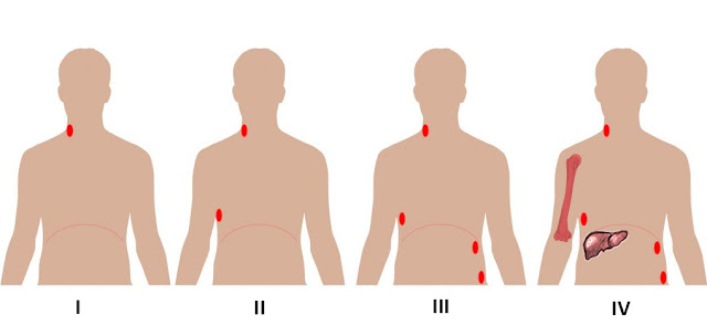 Lymphoma survival rates, causes, symptoms, treatment Lymphoma survival rates, causes, symptoms, treatment
