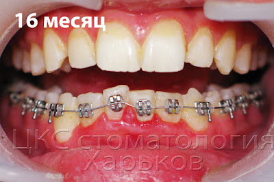 Установлена тонкая эластичная дуга соответствующая началу лечения Устранение осложнения отклеившегося брекета