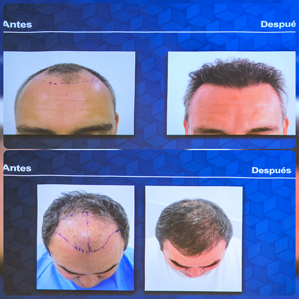 Kaloni,-tratamientos-caída-cabello Kaloni,-tratamientos-caída-cabello