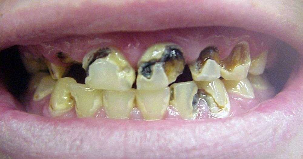 Is dental CARIES contagious?