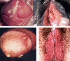 Pengobatan Herbal Penyakit Sipilis Secara Alami Pengobatan Herbal Penyakit Sipilis Secara Alami