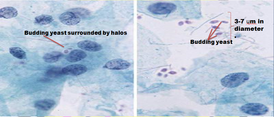 infections-in-pap-smear