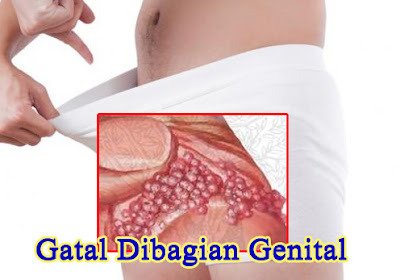 Gambar Kutil Kelamin Cara Cepat Menghilangkan Kutil Kelamin