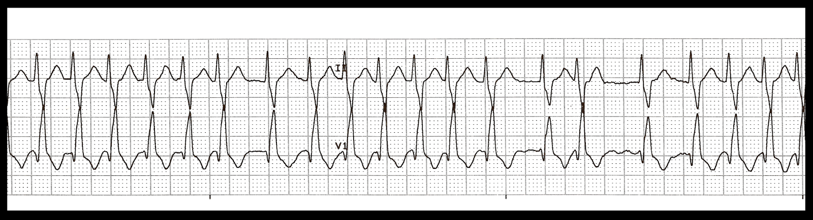 Practice EKG Strips 324