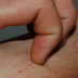 Early Signs Of Liver Disease That Can Save Your Life