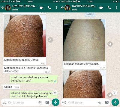 Obat Bintik bintik Merah Gatal Hingga Keluar Nanah Pada Selangkangan Obat Bintik bintik Merah Gatal Hingga Keluar Nanah Pada Selangkangan