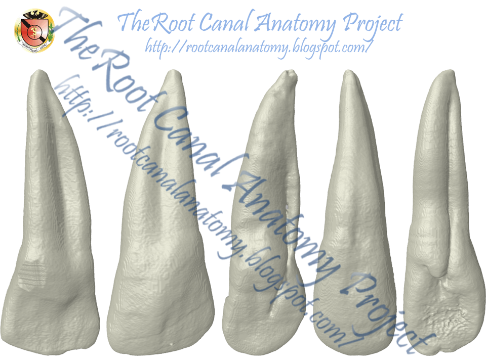 The Root Canal Anatomy Project Radicular Groove Maxillary Incisors