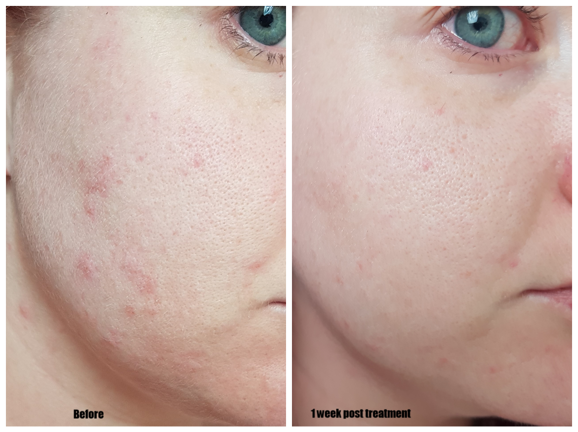 Microneedling & Me | Thérapie Clinic Before and after Microneedling & Me | Thérapie Clinic Before and after