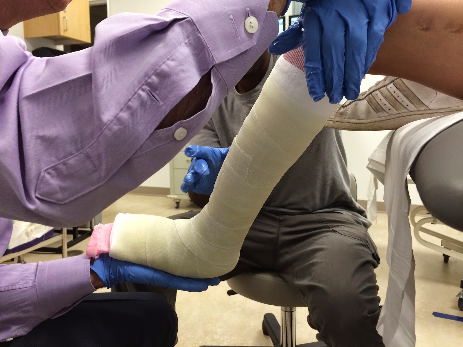 fibular hemimelia leg lengthening Pin Removal and Walking Cast