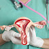 Cirurgia de mioma que preserva o útero aumenta chance de engravidar