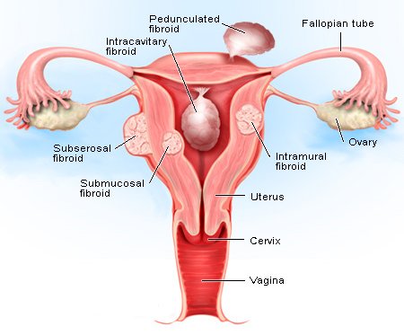Treatment For Uterine Fibroids
