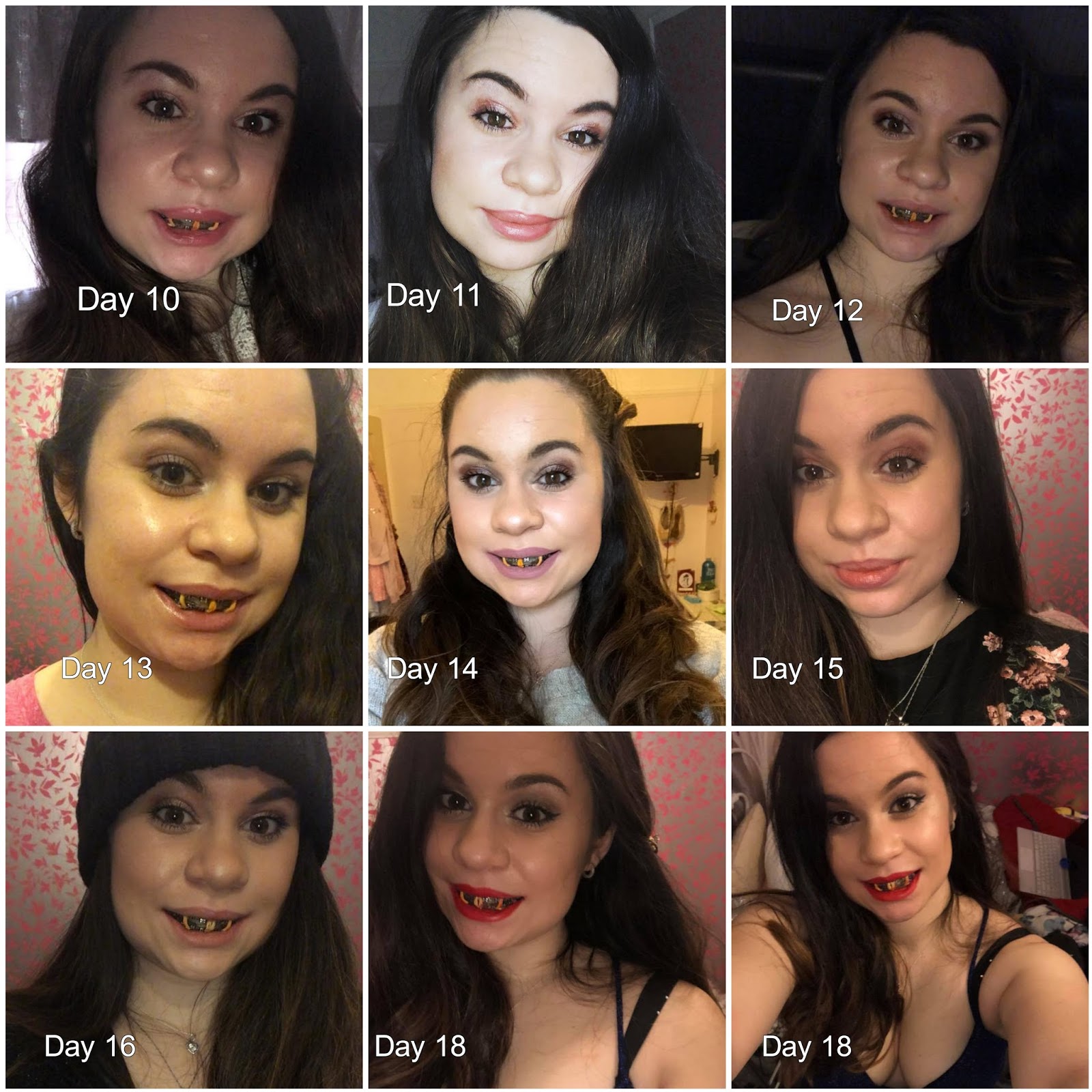 double jaw surgery journey