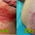 Obat alami ampuh utk eksim kering thumbnail
