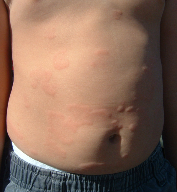Recognize skin complaints in children