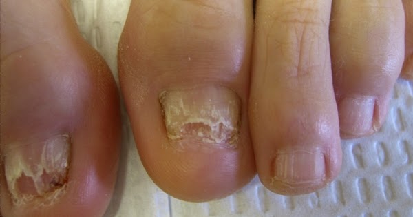 Oflomil el barniz del hongo de las uñas el precio en voronezhe