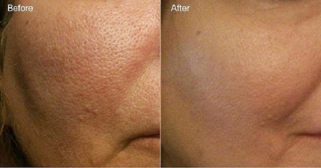 skin-pores-treatment