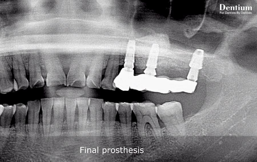 ORAL SURGERY Sinus elevation (Lateral & Crestal approach) using DASK