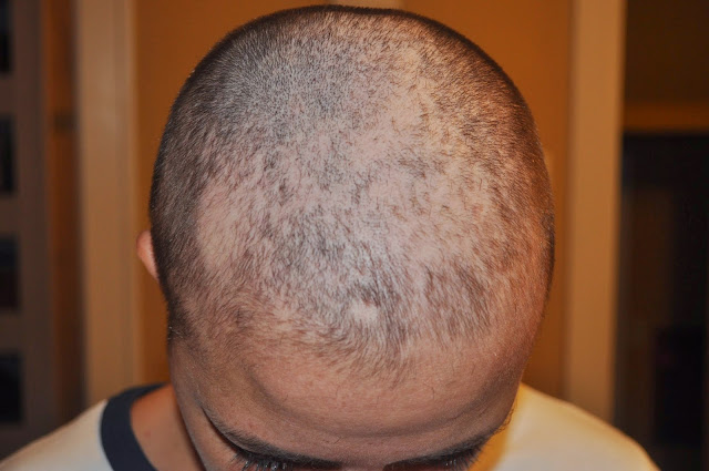 hair loss because of chemo, breast cancer, chemotherapy, pain