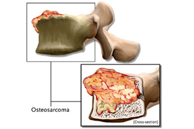 Osteosarkoma Pengobatan Osteosarkoma Tanpa Operasi