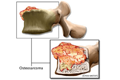 Pengobatan Osteosarkoma Tanpa Operasi