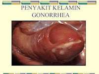 Harga Obat Penis Panas Keluar Nanah Saat Kencing Harga Obat Penis Panas Keluar Nanah Saat Kencing