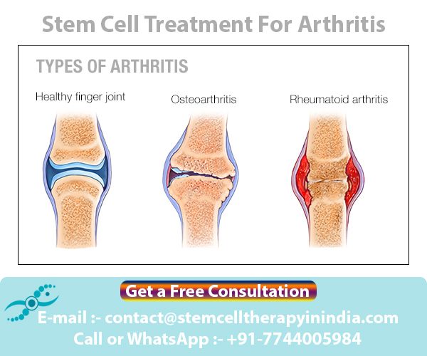 Stem Cell Therapy in India is very helpful for Arthritis Patients Stem Cell Therapy in India Blog