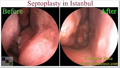 Septoplasty in Istanbul - The Nasal Septum - Deviated Septum - Septoplasty Definition - Symptoms of Deviated Septum - Septoplasty Price Istanbul - Septoplasty in Turkey - How Much Does Deviated Septum Repair? - Caudal Septoplasty - Septoplasty in Turkey - Septoplasty Turkey - Cost of Septoplasty - Symptoms of Nasal Septum Deviation - Septoplasty Operation - Diagnosis of Deviated Nasal Septum - Diagnosis of Deviated Septum - Differential Diagnosis of Deviated Nasal Septum - Nasal septal deviation - NSD - Types of deviated septum - Normal nasal septum - "C"- shaped deviation of the septum - "S"- shaped deviation of the septum - Dislocation of septal cartilage - Subluxation of septal cartilage - Dislocation of the caudal septum - Caudal septum deviation - Septal spur - Thickening of the nasal septum - Septum deviasyonu türleri - Nasal septal spur - Bone spur formation of the septum - Anterior dislocation of septum - Caudal dislocation of septum - How Much Does a Septoplasty Cost in Istanbul? - Septoplasty Operation Technique - Surgcal Technique of Septoplasty Operation - Nasal Splint Removal Video - Silicone Nasal Splints Advantages - Post-Operative Instruction For Septoplasty - Risks And Complications Of Septoplasty - Risks And Complications Of Deviated Septum Surgery - Nasal Septal Perforation - Nasal Septum Perforation - Nasal Septum Perforation Symptoms - Nasal Septum Perforation Diagnosis - Nasal Septum Perforation Treatment - Nasal Septum Perforation Closure - Nasal Surgical Repair Of Nasal Septum Perforation - Nasal Adhesion (Synechia) - Nasal Tip Ptosis - Saddle Nose Deformity - Saddle Nose Correction - Positive Health Effects Of Deviated Nasal Septum Surgery - Positive Health Effects Of Septoplasty Surgery - Functions of The Nose - Contact Point Headaches