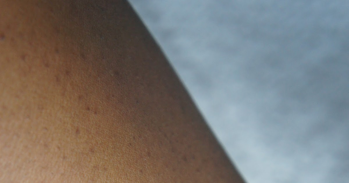 HOW I MANAGE MY KERATOSIS PILARIS Theplug