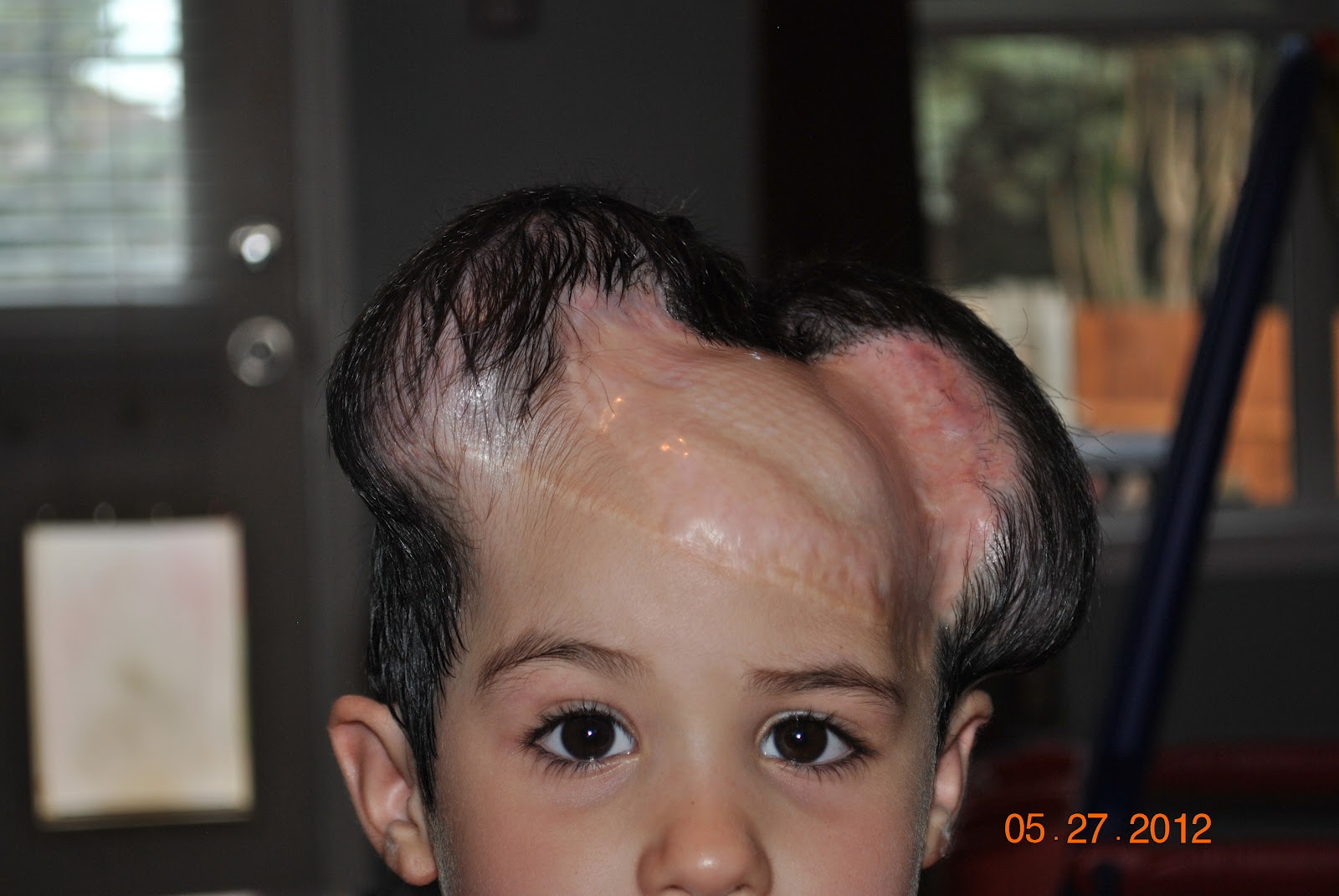 Age 4 Female Scalp Tissue Expanders Twenty Fourth Filling