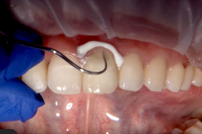 DENTAL CEMENTS Selecting the Right Provisional Cement