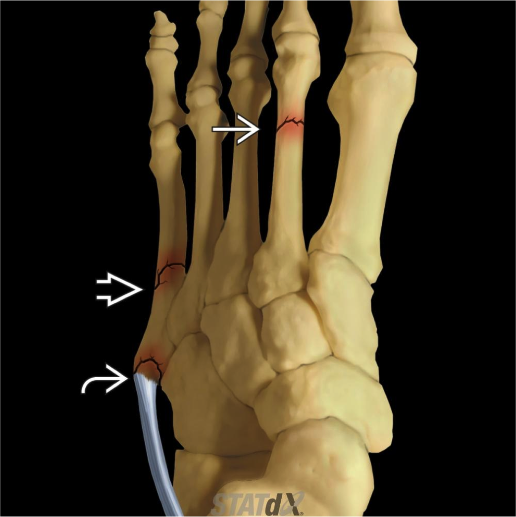 SportConsult MD Fractura proximal del 5to metatarsiano. La lesión de
