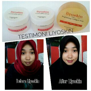 Cream Pemudar Bintik Hitam Akibat Sinar Matahari Liyoskin Cream Pemudar Bintik Hitam Akibat Sinar Matahari