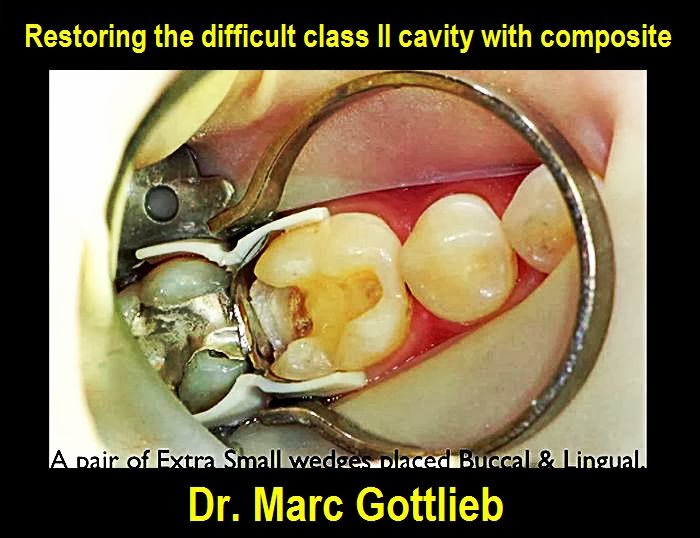 OPERATIVE DENTISTRY Restoring the difficult class II cavity with