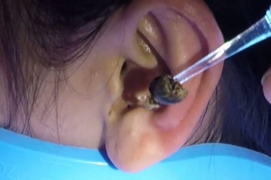 Ear wax buildup| causes, symptoms, signs and treatment .. how to remove