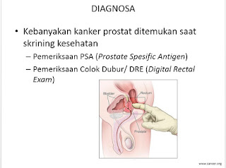 penyebab pencegahan pengobatan kanker prostat