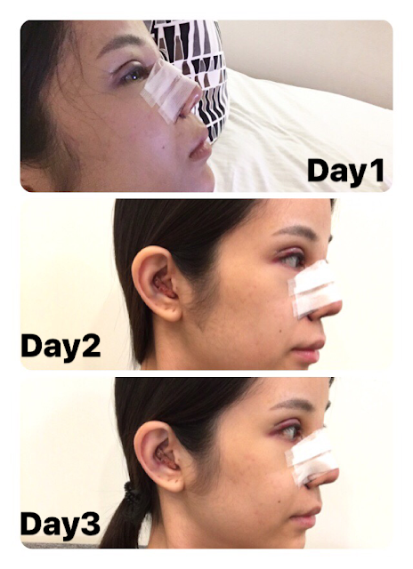 rhinoplasty nose eyelids epi epicanthoplasty zhongxiao dunhua zhongxiaodonglu