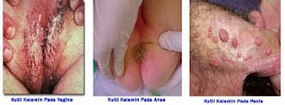 Penyakit Kutil Kelamin Penyakit Kutil Kelamin