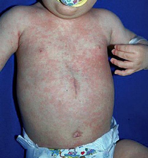 Skin Rashes in Children (Pictures) Health and Wellness Blog