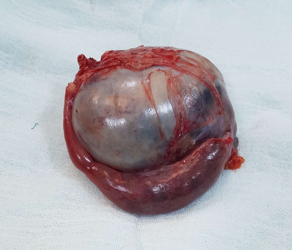 Overde 9 Cm Seromusinoz Kist Ultrason Ve Ameliyat Goruntusu Overde 9 Cm Seromusinoz Kist Ultrason Ve Ameliyat Goruntusu