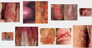 Foto penyembuhan penyakit sipilis yang sudah ada luka