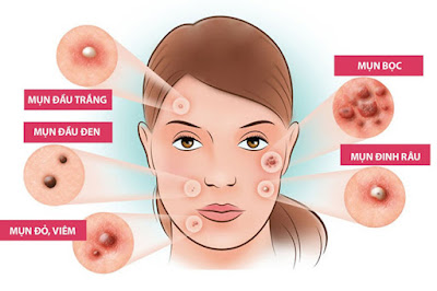 Tìm hiểu nguyên nhân gây mụn 23 1 laeg