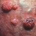 What is Condyloma lata - Definition, Symptoms, Causes, Treatment