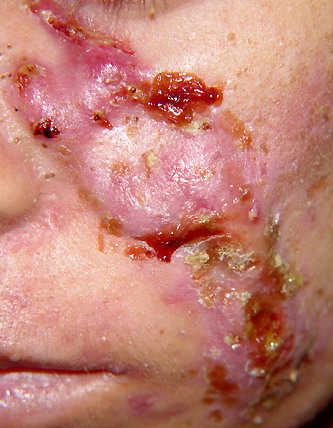 Scalp Acne Treatment, Acne Necrotica Miliaris and Varioliformi