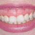 Niềng răng có khắc phục được vấn đề cười lộ rõ lợi không?