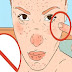 If You Squeeze This Type of Acne Stop Immediately Because You Risk Death!