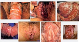 Pengobatan Alami Penyakit Sifilis Yang Mudah Dicari Pengobatan Alami Penyakit Sifilis Yang Mudah Dicari